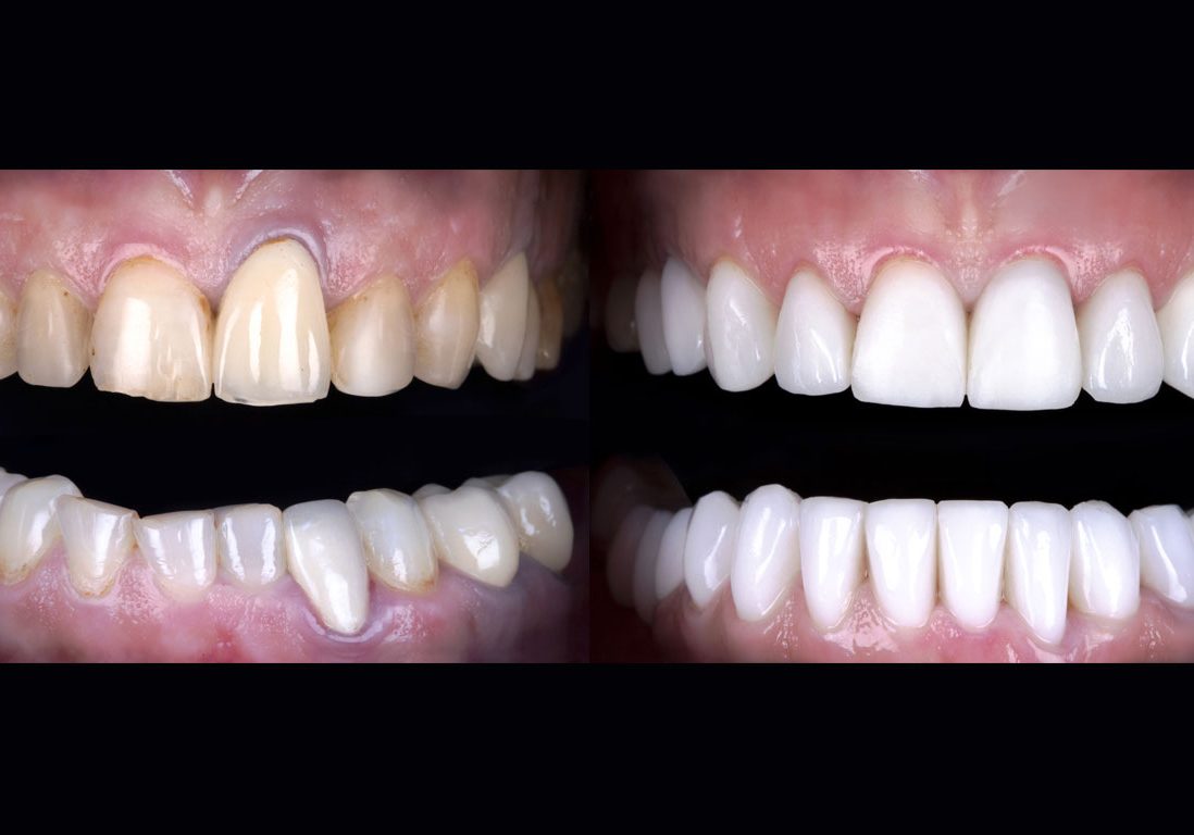 voor_na_damme_implant